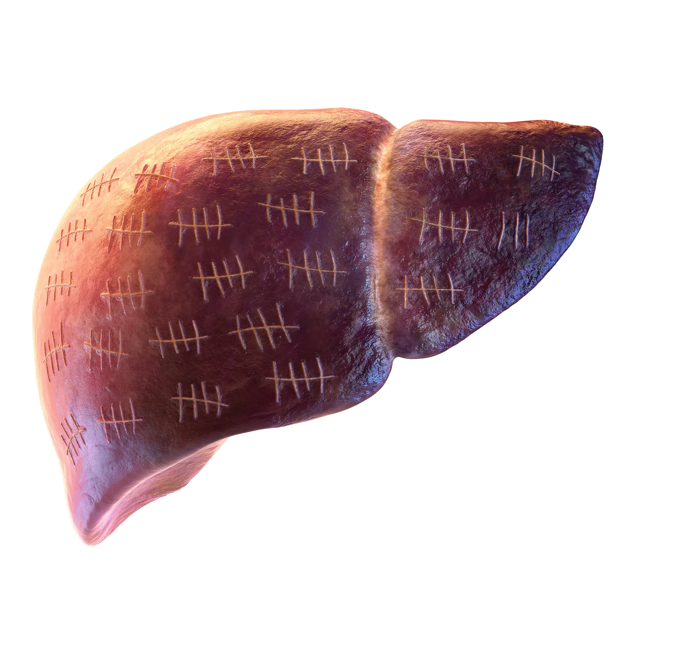 A damaged liver